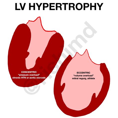 eccentric vs concentric Lv hypertrophy